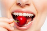 10 Foods To Avoid While Wearing Braces