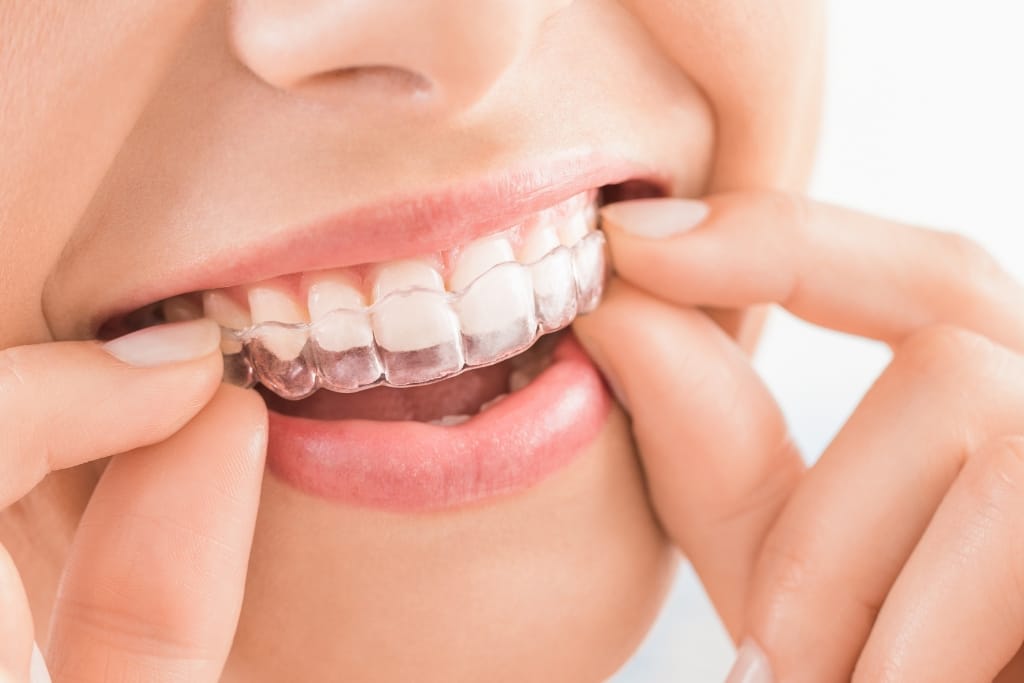 5 Tips For Invisalign Users