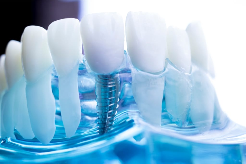 Guide To The Different Types Of Dental Implants