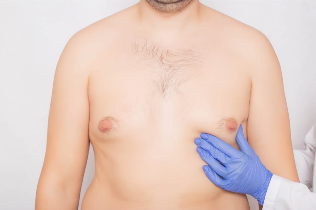 How To Tell If You Have Gynecomastia