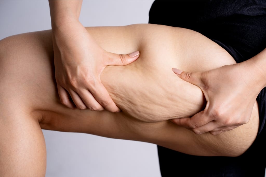 10 Common Concerns About Liposuction Answered