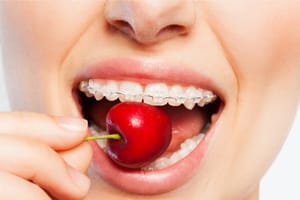 10 Foods To Avoid While Wearing Braces