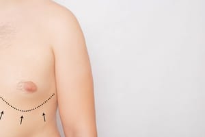Top 10 Questions You Must Ask About Gynecomastia Surgery Recovery